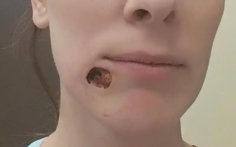 女子脸上长粉刺仅仅3天变成了3厘米的大洞