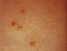 硬下疳怎么回事_硬下疳什么原因_硬下疳怎么办-求医网症状频道