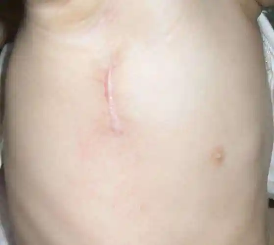 心脏手术的切口 (原创)