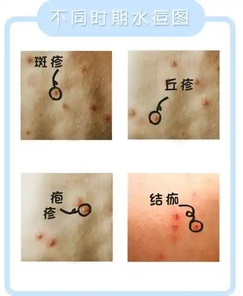 【健康提示】冬季水痘来袭,家长们要给孩子做好这些基础防护