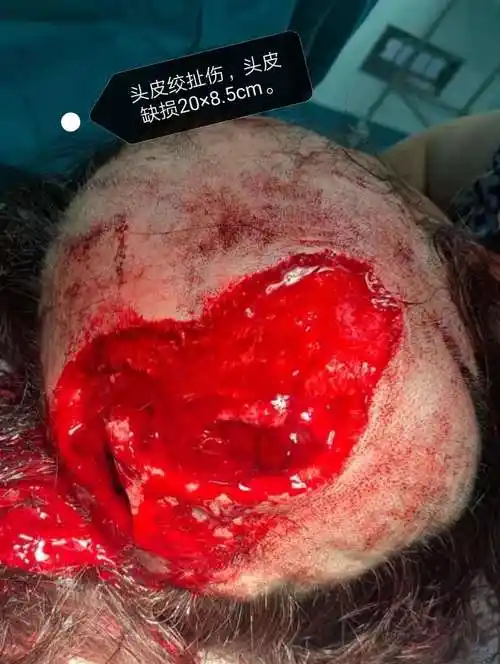 头皮绞扯撕脱伤,头皮缺损20×8cm.