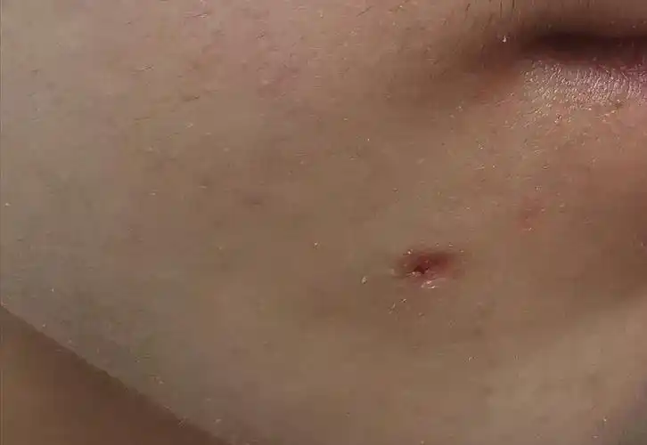 求助,睡觉把激光打痣之后的痂蹭掉了