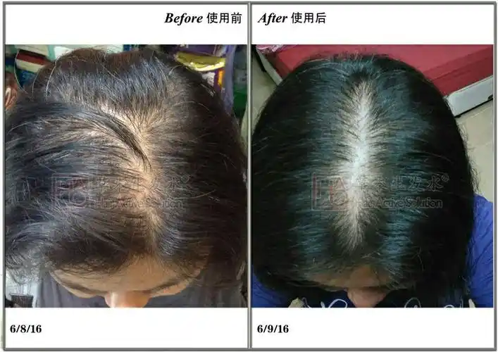 生发案例 - 美篇