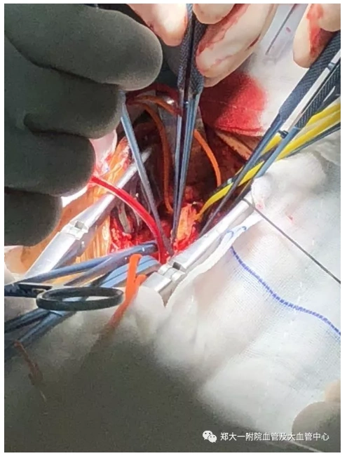 颈动脉狭窄的支架植入及开放手术cas与cea