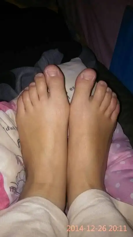 穿高跟鞋穿的,脚趾头都变形了,大脚趾根都突出了,该怎么保护呢?