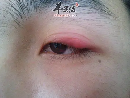 眼周浮肿问题要怎么解决呢