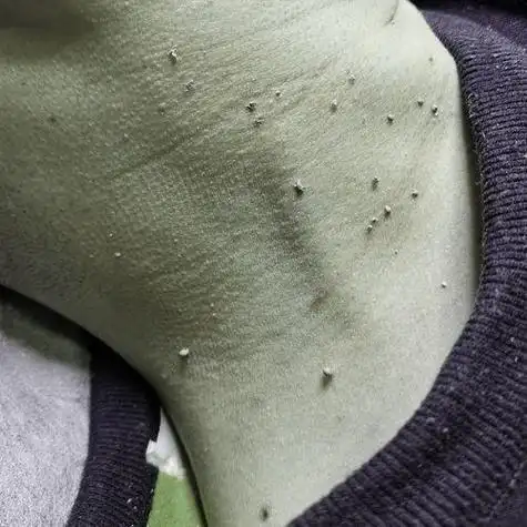 丝状疣不治疗可以自愈吗