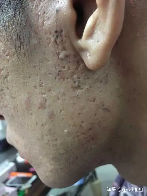 尤其是大到插秧,大到可以塞芝麻,甚至毛孔又粗又圆像冲天炮那种,真的