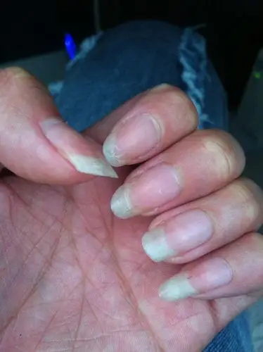 指甲有这样的裂纹,怎么回事?