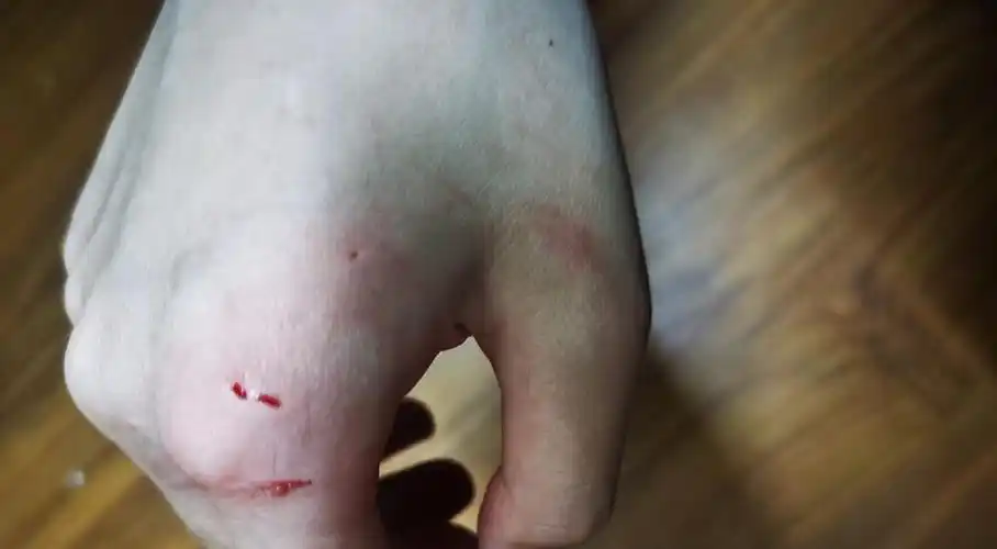 请问被家里的猫咬成这样子要去打针吗?(去打了)