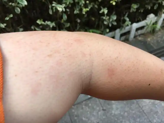 手臂红斑!去医院看了说是皮炎或是玫瑰糠疹?