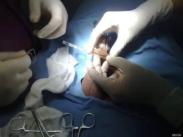 【进展】包皮套扎全过程高清图片