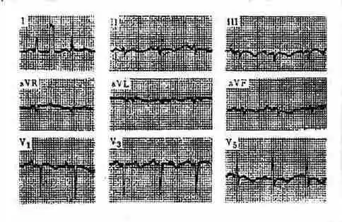 缩窄性心包炎constrictivepericarditis