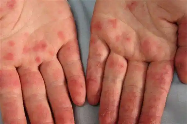 红斑狼疮手上出现红斑图片