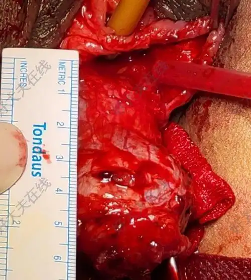 尿道癌_尿道癌 - 好大夫在线