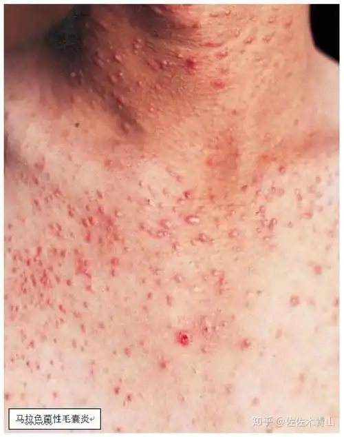 前胸后背的毛囊炎总治不好可能得的是真菌性毛囊炎