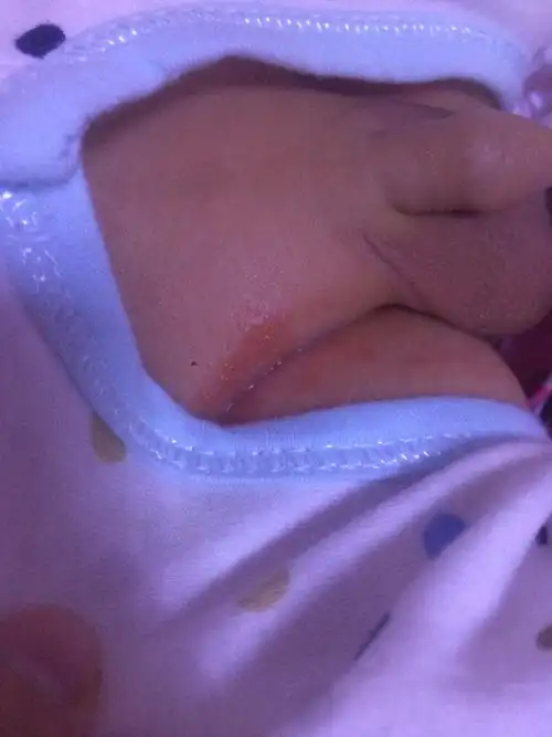 宝宝胯下裂开了.怎么办?该擦什么药膏才能好呢