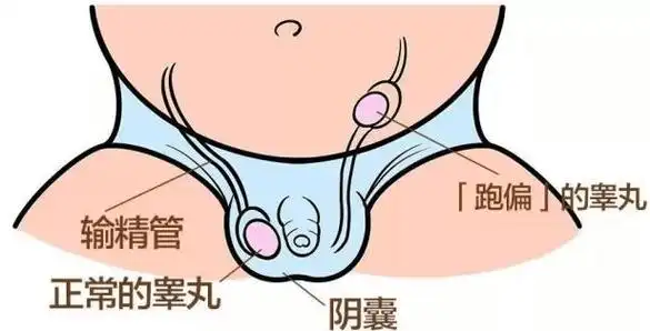 睾丸在正常发育过程中会从腰部腹膜后下降至阴囊,如果没有出现下降或