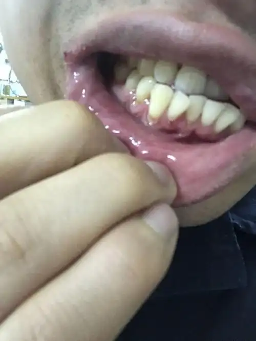 压根牙龈刷出来怎么办?