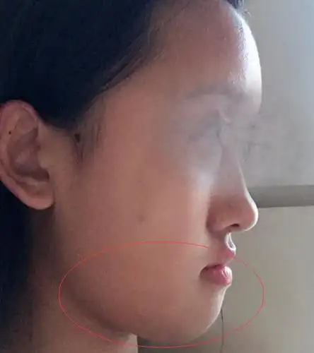 这样的侧面脸型是什么问题为什么我的下巴与嘴之间没有沟
