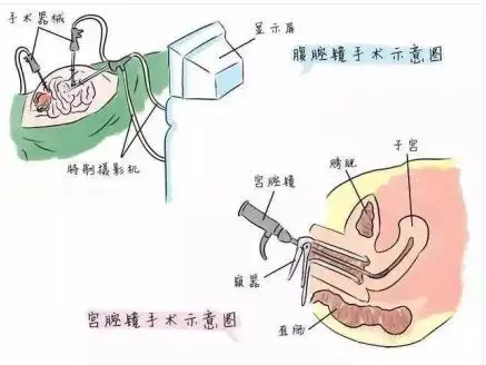 宫腹腔镜治疗不孕症效果好吗?