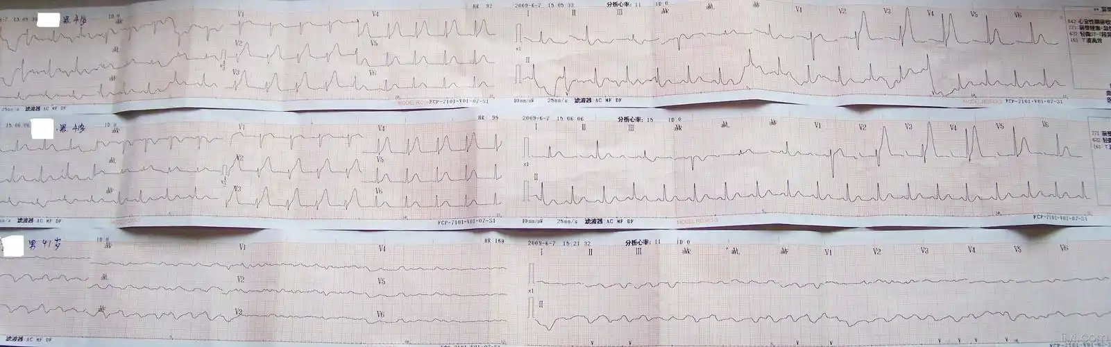 一例猝死的心电图请大家帮忙看看