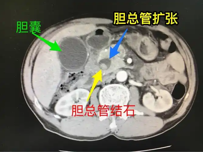 腹部ct可见明显胆总管扩张增粗,其内多发结石,肝内胆管也伴随扩张