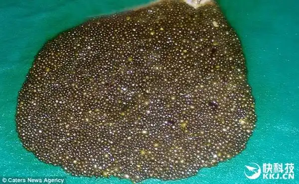 医生吓傻了!印度大妈胆囊中取出1.2万颗胆结石