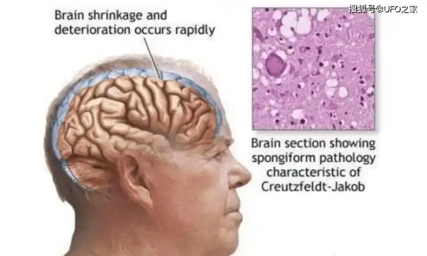 烹煮都杀不死的朊病毒致死率100无药可救感染后有多恐怖