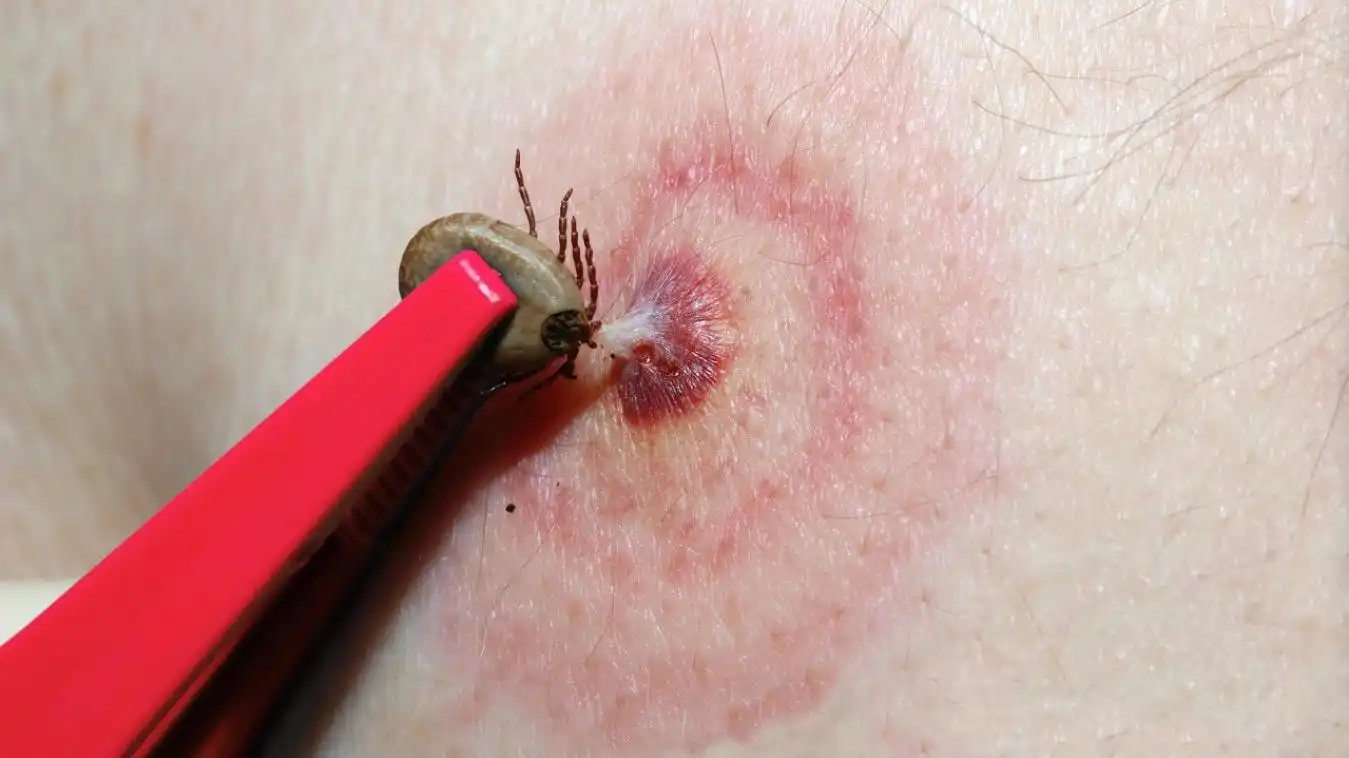 蜱虫叮咬钻入皮肤,发炎溃烂如何取出?用它涂抹别用手拔