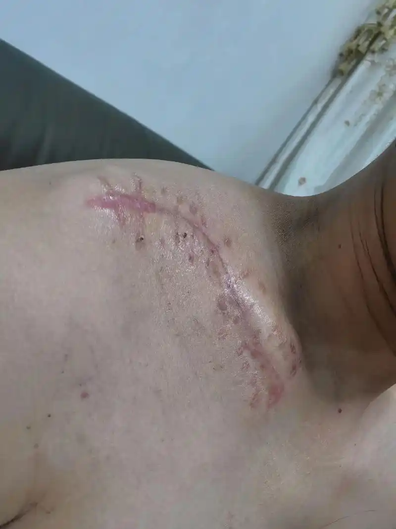 锁骨粉碎性骨折,这该死的意外!钢板固定上一个月了,异物 - 抖音