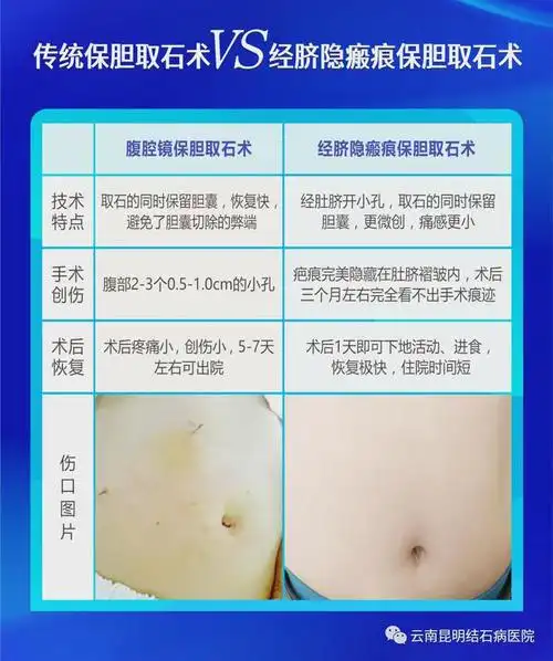 手术|胆结石|胆囊癌|云南省|胆囊结石_网易订阅