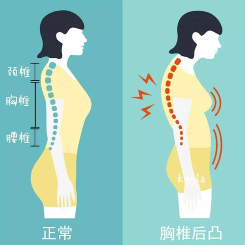 我们可以这样理解,胸椎后凸是脊柱纵向弯曲变形,圆肩含胸是肩膀横向