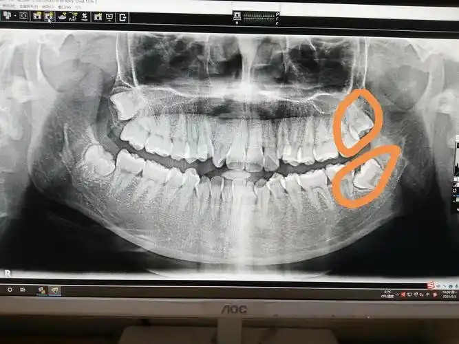 同时拔两颗阻生智齿行吗