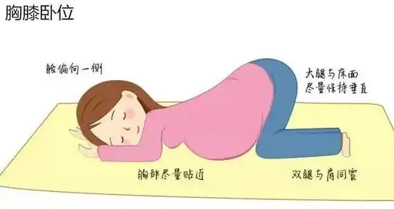 没有任何并发症的健康孕妈咪可以试着做一个膝胸卧位法体操来纠正,但