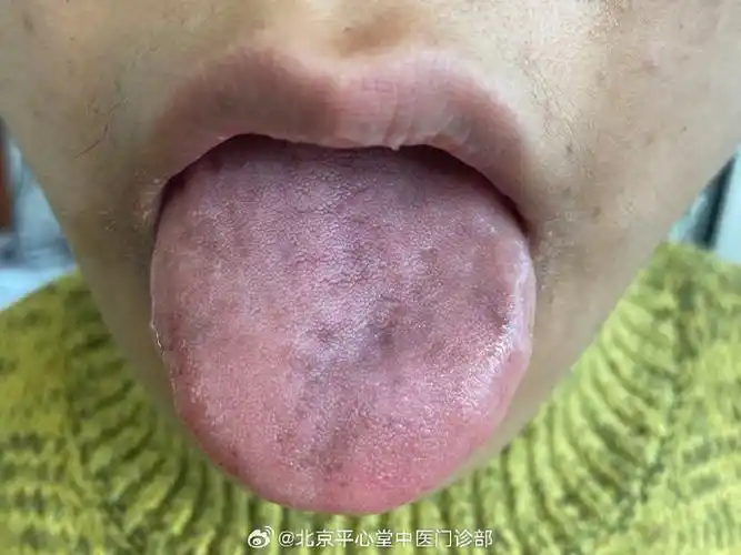 舌体全部显青色或紫色,或局部舌体出现青紫色斑点,都称为青紫舌.