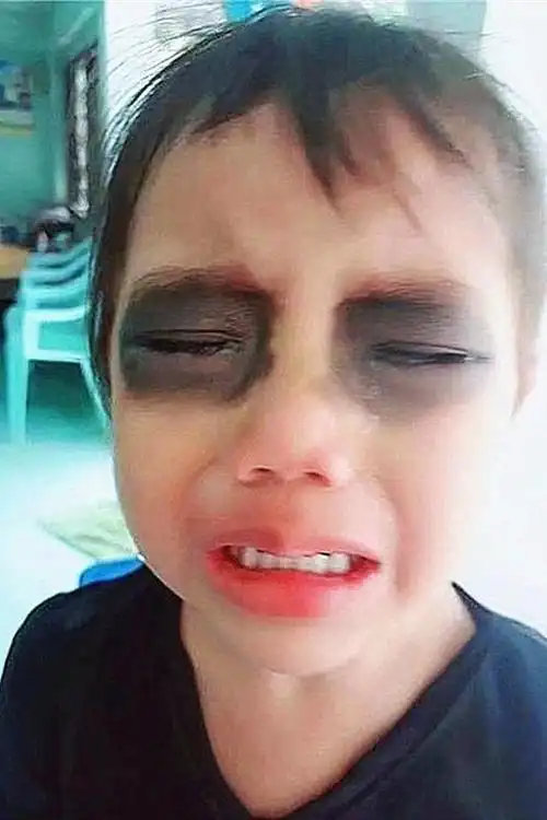 孩子玩手机坏眼睛图片(宝宝玩手机眼睛玩坏了图片)