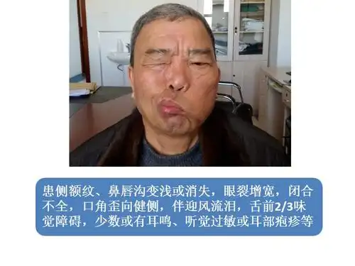 面神经麻痹ppt课件
