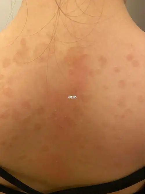 女儿背上突然长了好多这个斑是什么回事?怎么办呀