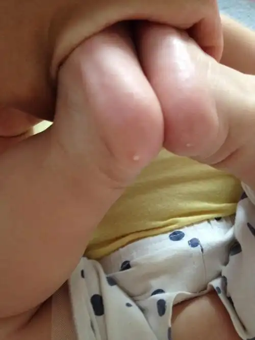 宝宝脚后跟长了两个小白疙瘩还很对称!请问是怎么回事!急!急!