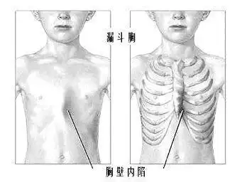 4岁孩子成严重鸡胸宝妈羞愧医生却着急