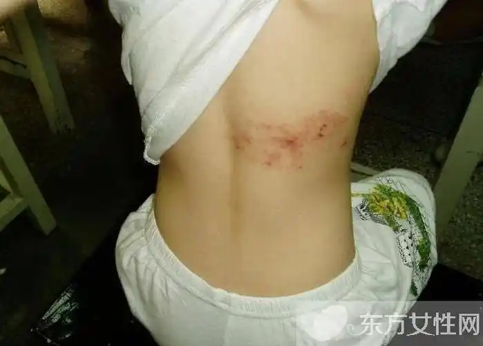 蛇盘疮的最佳治疗方法 这些早期症状需注意!