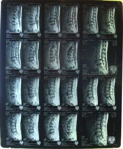 腰间盘突出怎样治疗合适