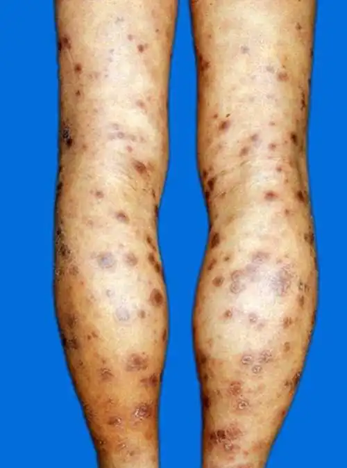 人得了一期梅毒怎么办图片