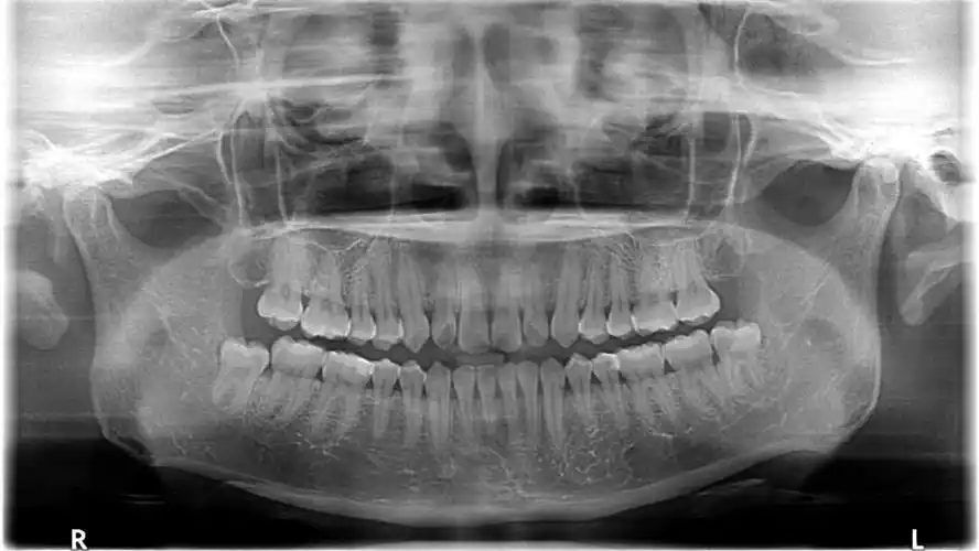 其实去年我就牙疼过,后来去拍牙片就发现有两颗智齿了,从我的牙片来看