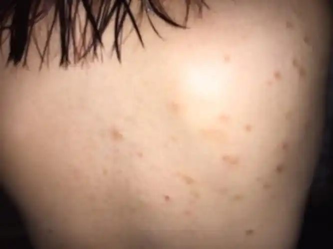 背后长了这种斑点斑点上有轻微蜕皮现象去医院看配了药膏刚