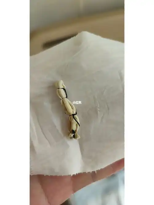 混合痔 肛瘘手术第十天