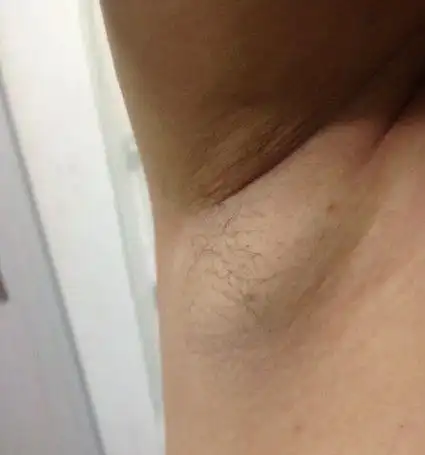 腋下淋巴肿大图片