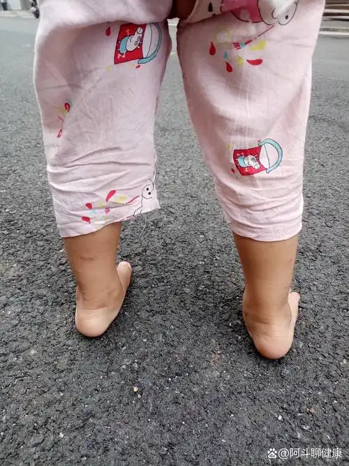一岁半,足外翻