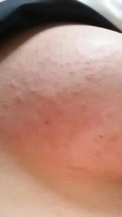 有孕妈乳房痒,两边还长疹子的吗